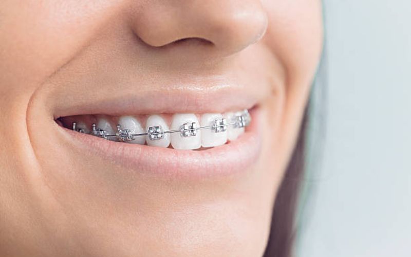 Braces Treatment in Gurgaon