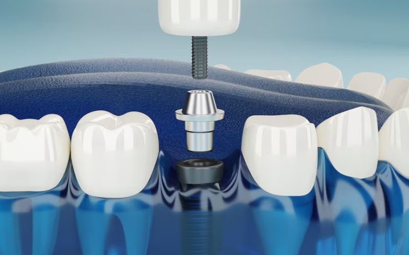 Dental Implant Clinic in Gurugram